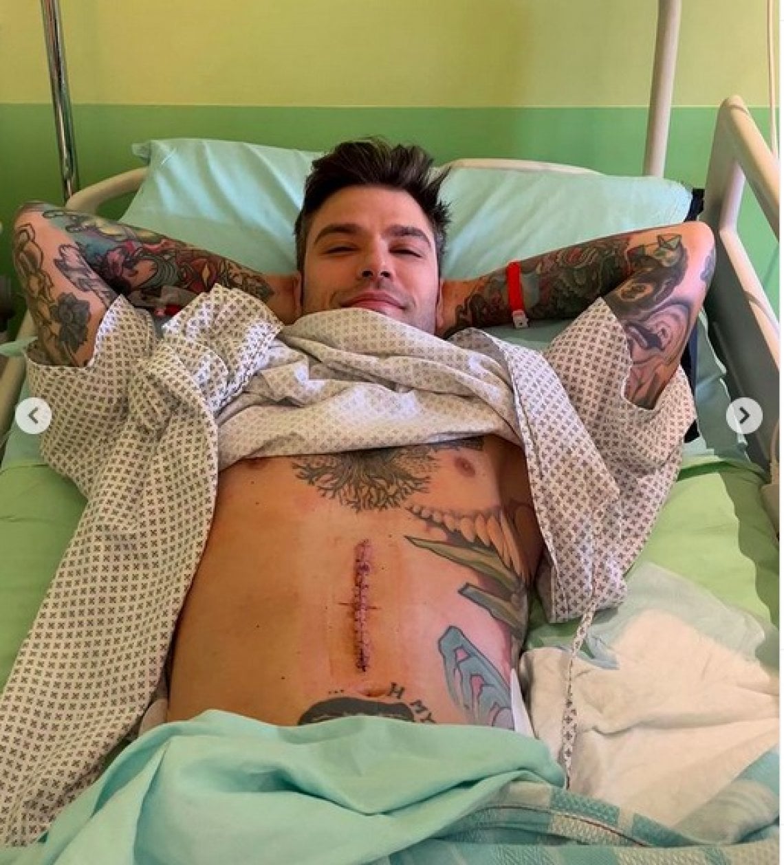 Fedez mostra la cicatrice post operatoria